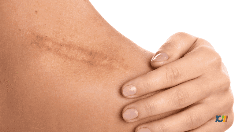 Cicatriz de cirurgia na pele sendo tocada por uma mão, ilustrando recuperação após ferimento.